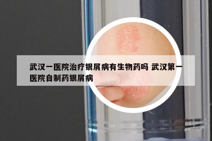 武汉一医院治疗银屑病有生物药吗 武汉第一医院自制药银屑病
