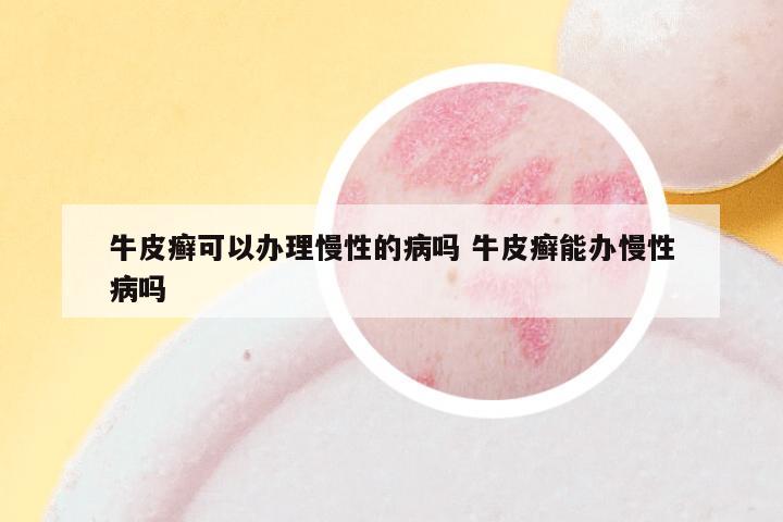 牛皮癣可以办理慢性的病吗 牛皮癣能办慢性病吗