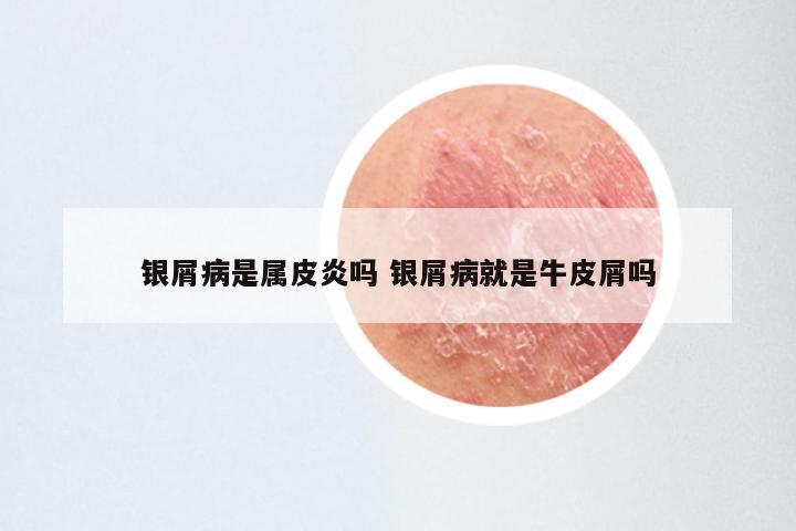 银屑病是属皮炎吗 银屑病就是牛皮屑吗