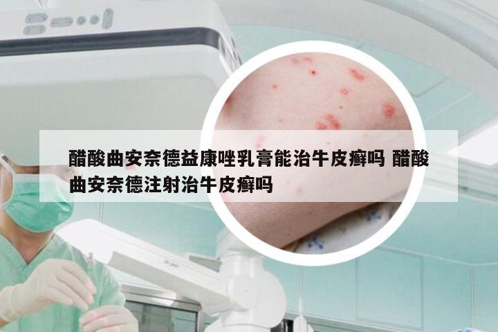 醋酸曲安奈德益康唑乳膏能治牛皮癣吗 醋酸曲安奈德注射治牛皮癣吗
