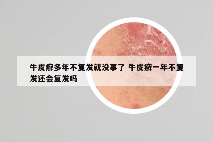 牛皮癣多年不复发就没事了 牛皮癣一年不复发还会复发吗