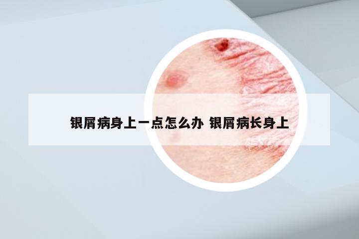 银屑病身上一点怎么办 银屑病长身上