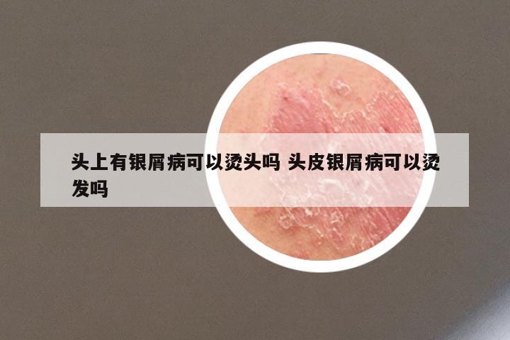 头上有银屑病可以烫头吗 头皮银屑病可以烫发吗