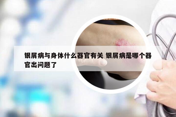 银屑病与身体什么器官有关 银屑病是哪个器官出问题了