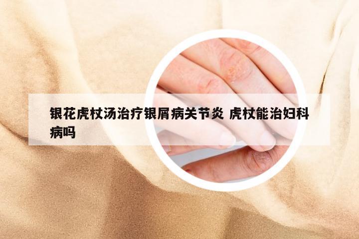 银花虎杖汤治疗银屑病关节炎 虎杖能治妇科病吗