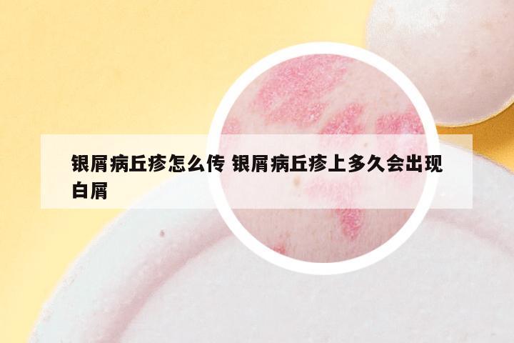 银屑病丘疹怎么传 银屑病丘疹上多久会出现白屑