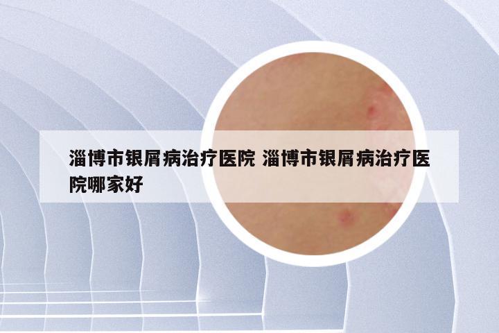 淄博市银屑病治疗医院 淄博市银屑病治疗医院哪家好