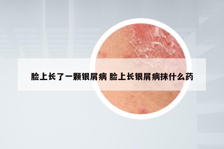 脸上长了一颗银屑病 脸上长银屑病抹什么药