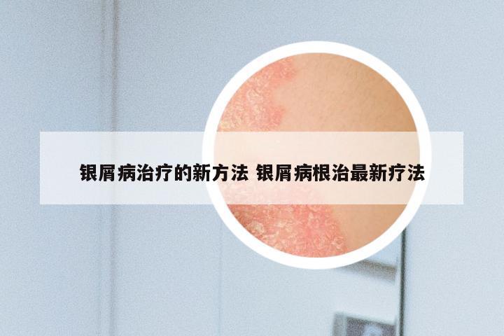 银屑病治疗的新方法 银屑病根治最新疗法