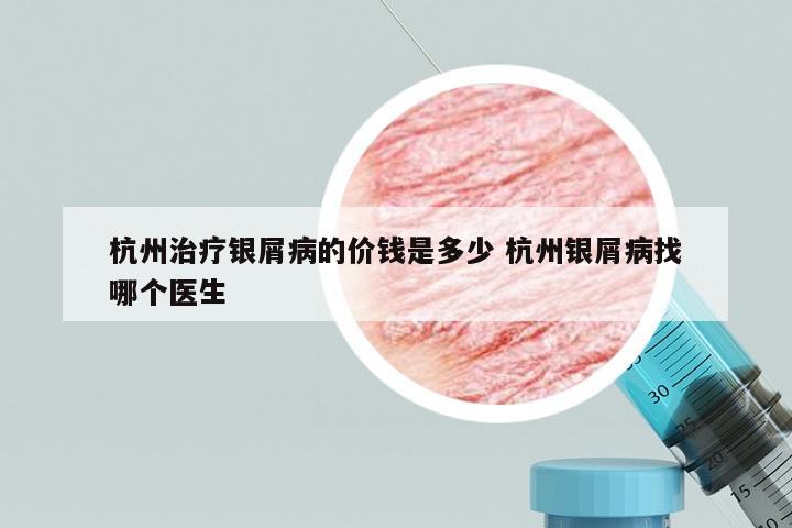 杭州治疗银屑病的价钱是多少 杭州银屑病找哪个医生