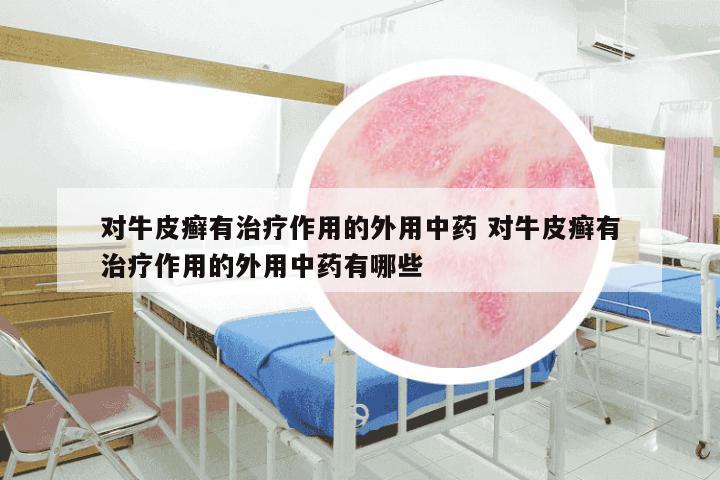 对牛皮癣有治疗作用的外用中药 对牛皮癣有治疗作用的外用中药有哪些