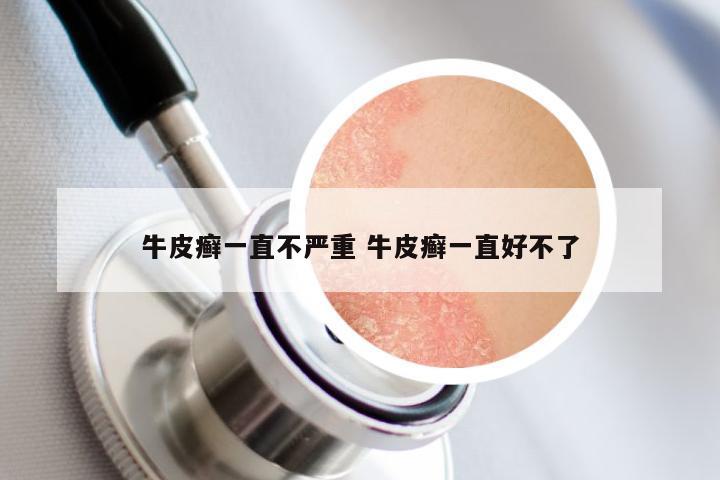 牛皮癣一直不严重 牛皮癣一直好不了