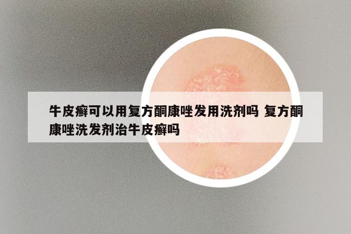 牛皮癣可以用复方酮康唑发用洗剂吗 复方酮康唑洗发剂治牛皮癣吗
