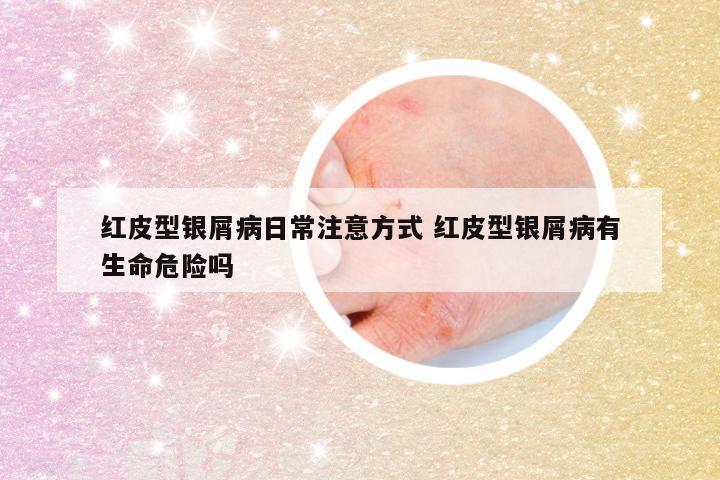 红皮型银屑病日常注意方式 红皮型银屑病有生命危险吗