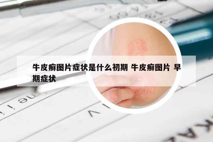 牛皮癣图片症状是什么初期 牛皮癣图片 早期症状