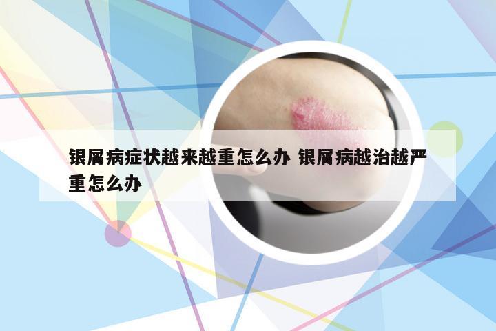 银屑病症状越来越重怎么办 银屑病越治越严重怎么办