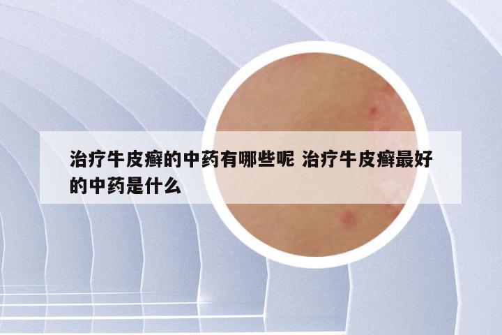 治疗牛皮癣的中药有哪些呢 治疗牛皮癣最好的中药是什么