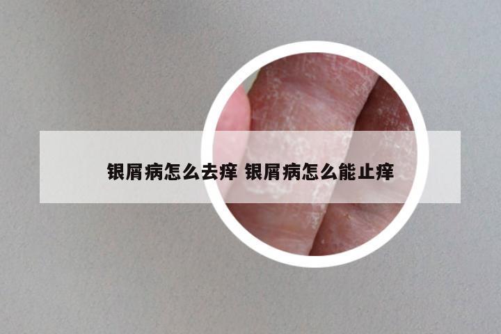 银屑病怎么去痒 银屑病怎么能止痒
