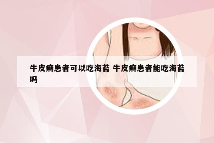 牛皮癣患者可以吃海苔 牛皮癣患者能吃海苔吗