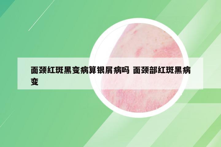 面颈红斑黑变病算银屑病吗 面颈部红斑黑病变