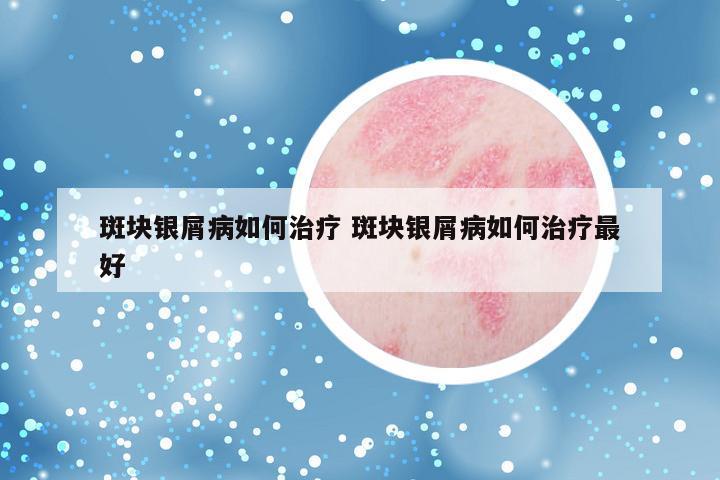 斑块银屑病如何治疗 斑块银屑病如何治疗最好