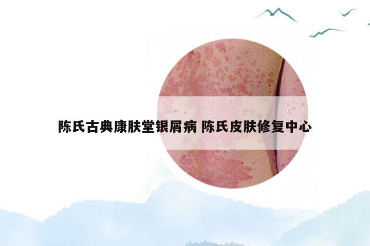 陈氏古典康肤堂银屑病 陈氏皮肤修复中心