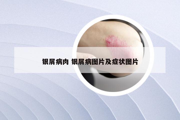 银屑病肉 银屑病图片及症状图片