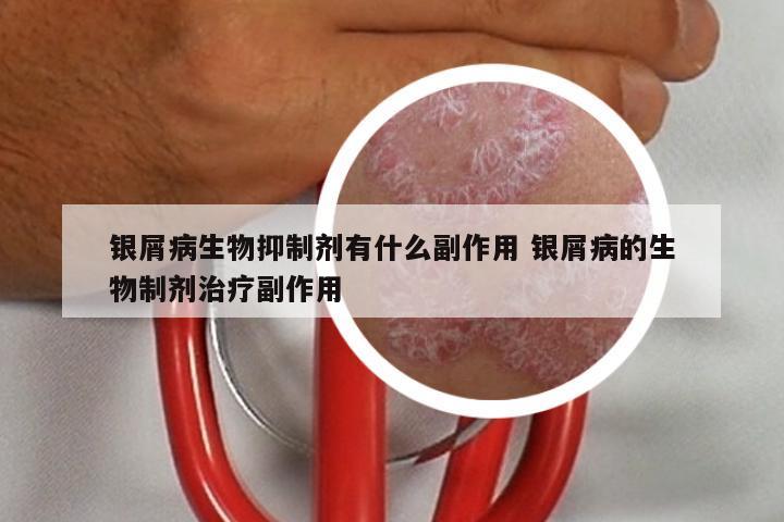 银屑病生物抑制剂有什么副作用 银屑病的生物制剂治疗副作用