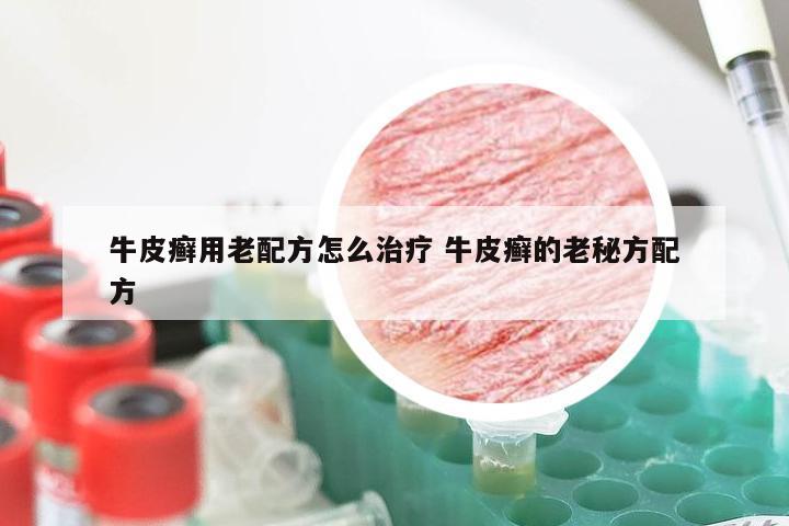 牛皮癣用老配方怎么治疗 牛皮癣的老秘方配方
