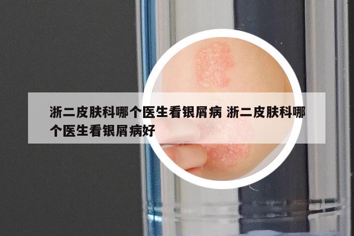浙二皮肤科哪个医生看银屑病 浙二皮肤科哪个医生看银屑病好
