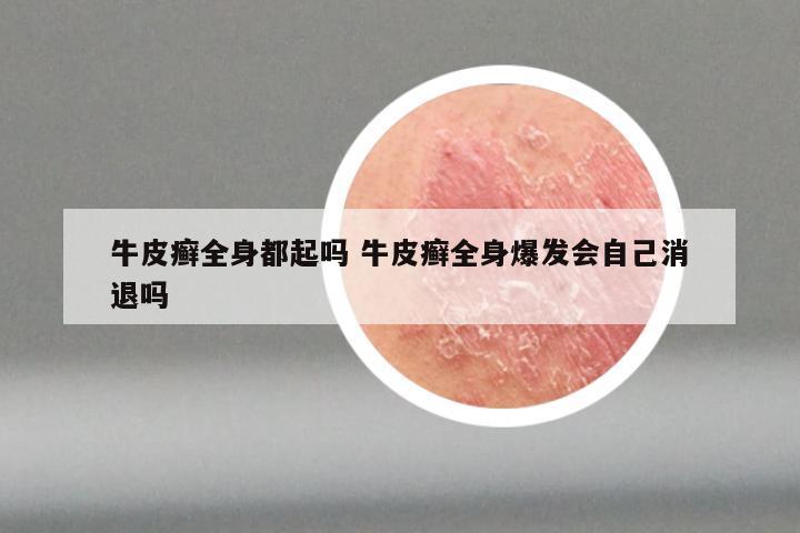 牛皮癣全身都起吗 牛皮癣全身爆发会自己消退吗