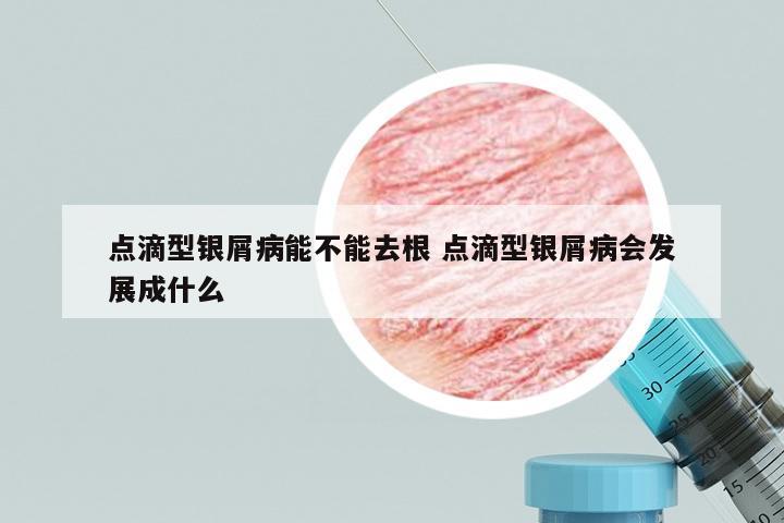 点滴型银屑病能不能去根 点滴型银屑病会发展成什么