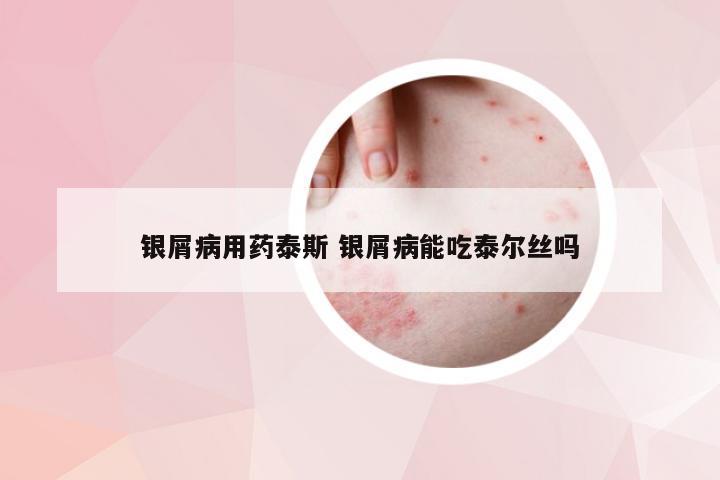 银屑病用药泰斯 银屑病能吃泰尔丝吗