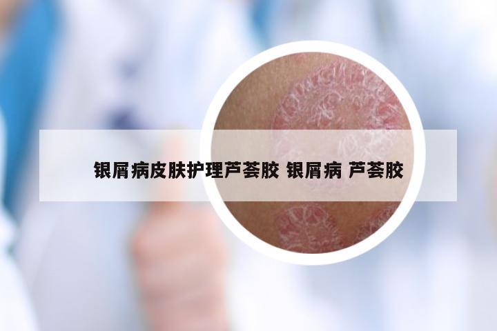 银屑病皮肤护理芦荟胶 银屑病 芦荟胶