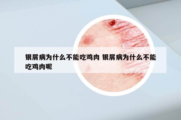 银屑病为什么不能吃鸡肉 银屑病为什么不能吃鸡肉呢
