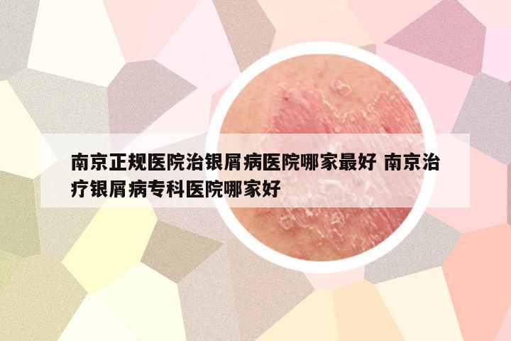 南京正规医院治银屑病医院哪家最好 南京治疗银屑病专科医院哪家好