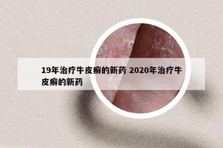 19年治疗牛皮癣的新药 2020年治疗牛皮癣的新药