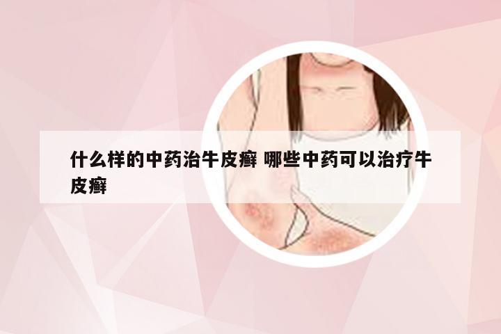 什么样的中药治牛皮癣 哪些中药可以治疗牛皮癣