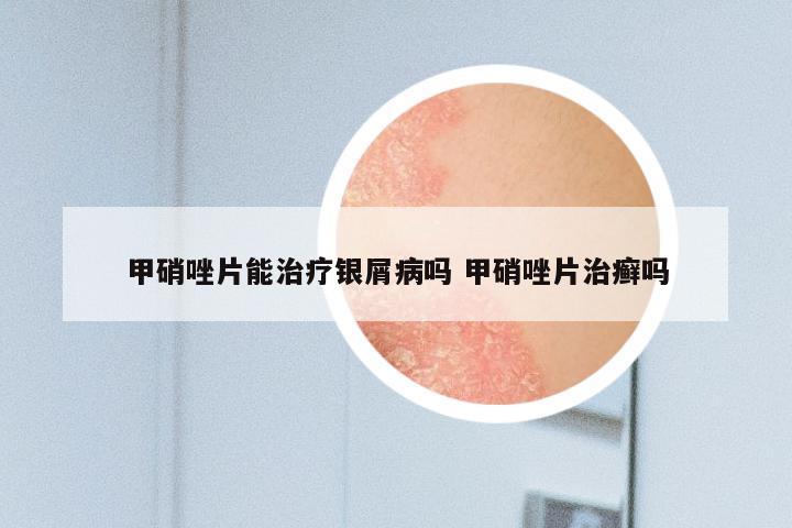 甲硝唑片能治疗银屑病吗 甲硝唑片治癣吗
