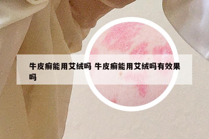 牛皮癣能用艾绒吗 牛皮癣能用艾绒吗有效果吗