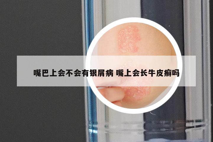嘴巴上会不会有银屑病 嘴上会长牛皮癣吗