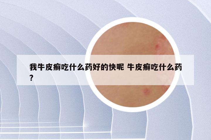 我牛皮癣吃什么药好的快呢 牛皮癣吃什么药?