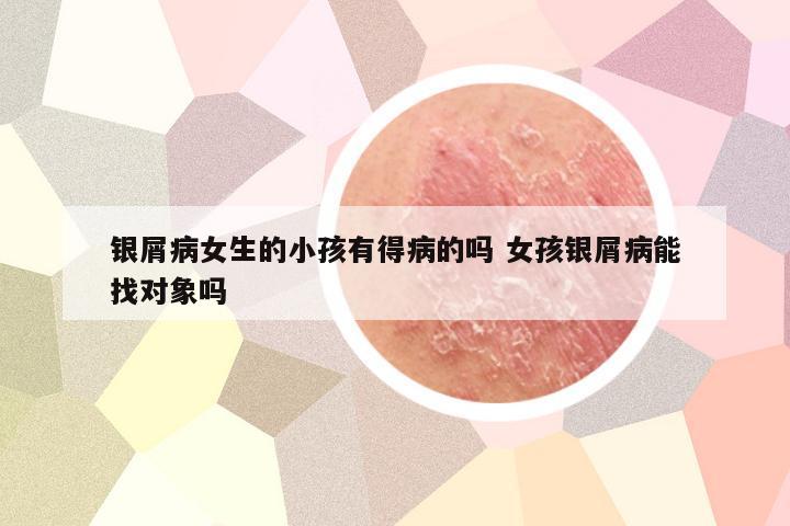 银屑病女生的小孩有得病的吗 女孩银屑病能找对象吗