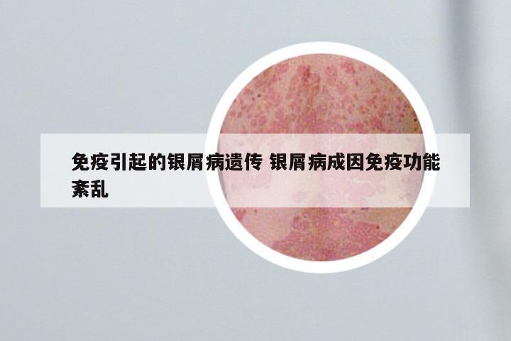 免疫引起的银屑病遗传 银屑病成因免疫功能紊乱