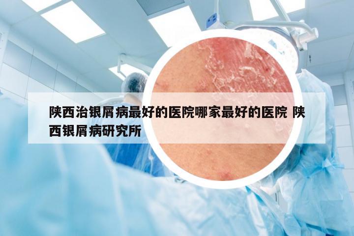 陕西治银屑病最好的医院哪家最好的医院 陕西银屑病研究所