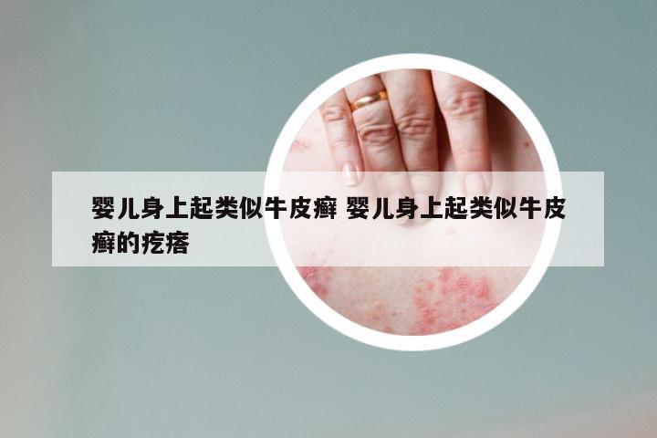 婴儿身上起类似牛皮癣 婴儿身上起类似牛皮癣的疙瘩