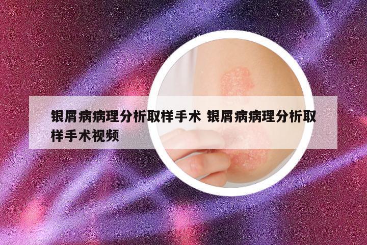 银屑病病理分析取样手术 银屑病病理分析取样手术视频