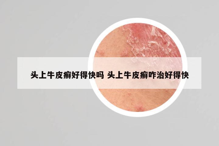 头上牛皮癣好得快吗 头上牛皮癣咋治好得快