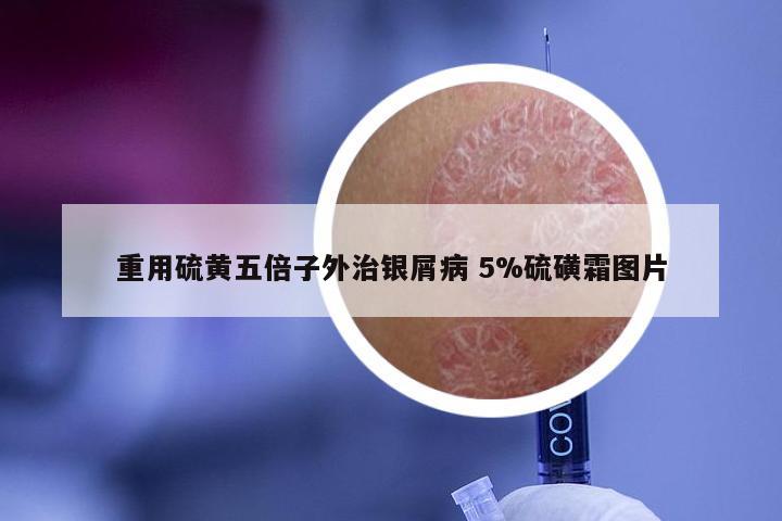 重用硫黄五倍子外治银屑病 5%硫磺霜图片