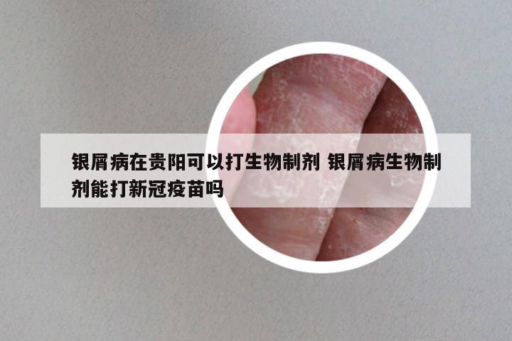 银屑病在贵阳可以打生物制剂 银屑病生物制剂能打新冠疫苗吗